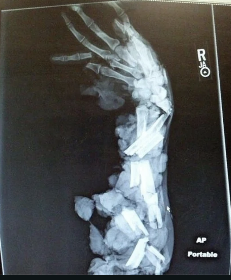 X-ray image showing mangled bones and flesh