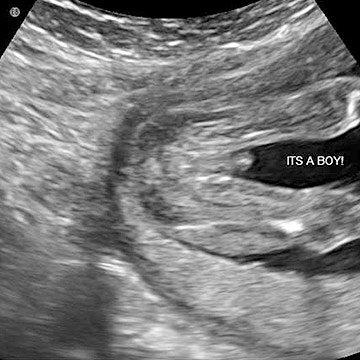 We've partnered with the American Institute of Ultrasound Medicine (AIUM), Johns Hopkins, and the March of Dimes to create this unique peak into Baby's development inside the womb. These images reveal all the intricate details of your baby's growth -- from a collection of cells to a full-term newborn. While most women may only receive one or two ultrasounds during pregnancy, which is normal, this slideshow of the 2nd trimester of pregnancy gives you a look at each week of development.