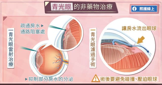 青光眼非藥物治療。