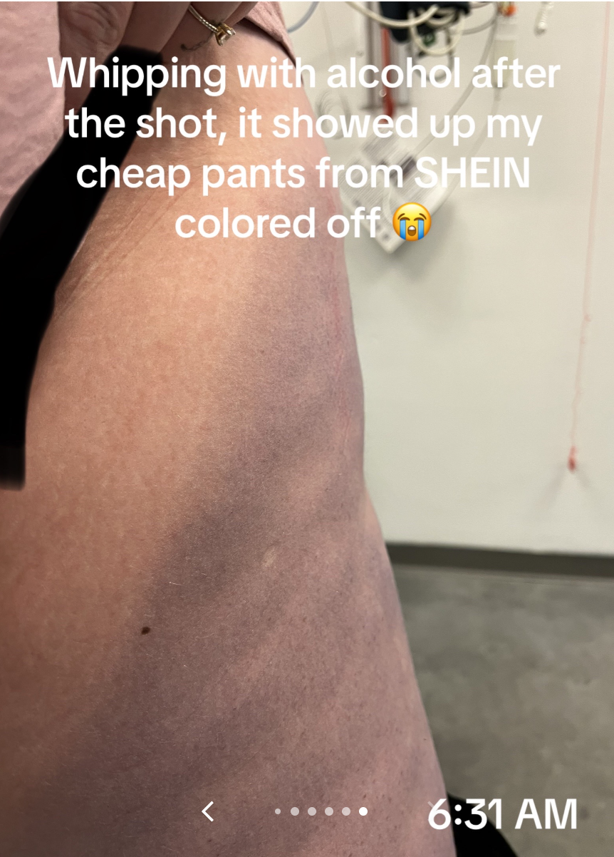 A person shows their arm with color transfer stains from clothing with text: "Wiping with alcohol after the shot, it showed up my cheap pants from Shein colored off"