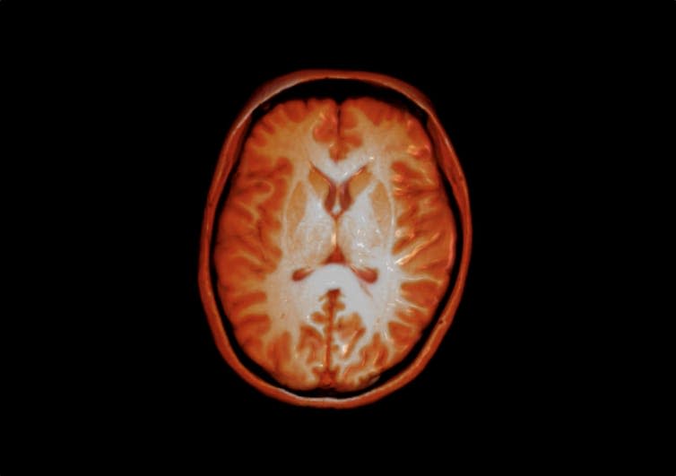 Red cross-section of a brain against black background.