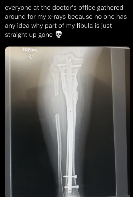 An X-ray showing a missing part of the person's fibula