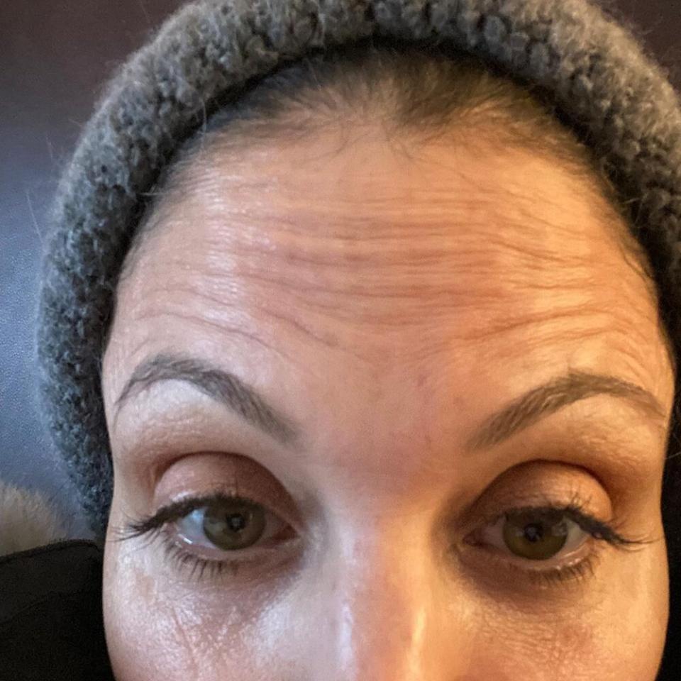 bethenny frankel no botox