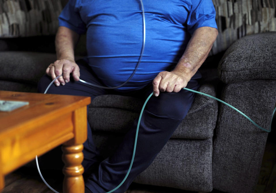 Retired coal miner James Bounds, who has pneumoconiosis, more commonly known as “black lung," poses for a photo at his home in Oak Hill, W.Va., Thursday, July, 13, 2023. Bounds said nothing can be done to reverse the debilitating illness he was diagnosed with at 37 in 1984. But he doesn't want others to suffer the same fate. (AP Photo/Chris Jackson)