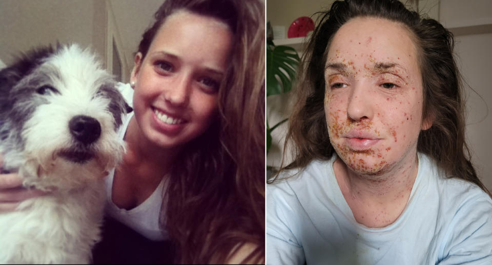 Mare cuddles her dog in the image on the left, while on the right she shows her face covered in flaking skin after stopping topical steroid use.