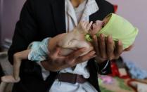 Child malnutrition at record highs in parts of Yemen -U.N. survey