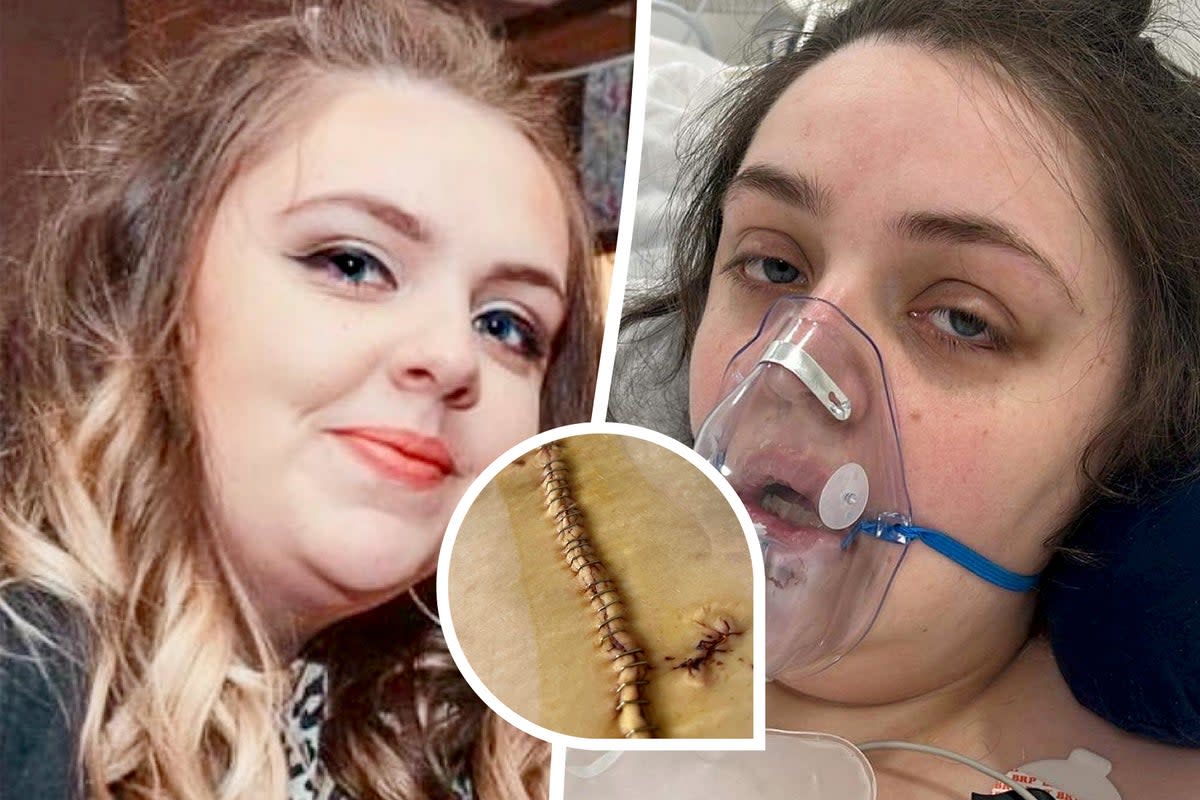 Chloe Quick who was put in a medically induced coma after having surgery for a gastric sleeve in Turkey (Leah Mattson/Quick Family/SWNS)