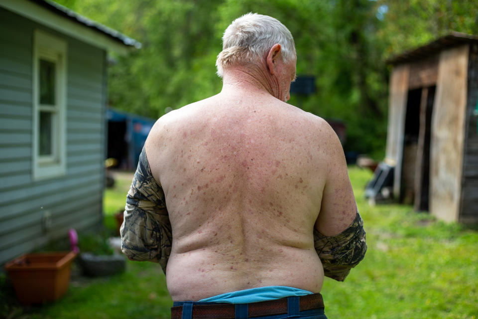 The water leaves behind a thick sludge and a rash across Berlyn's skin. (Hannah Rappleye / NBC News)