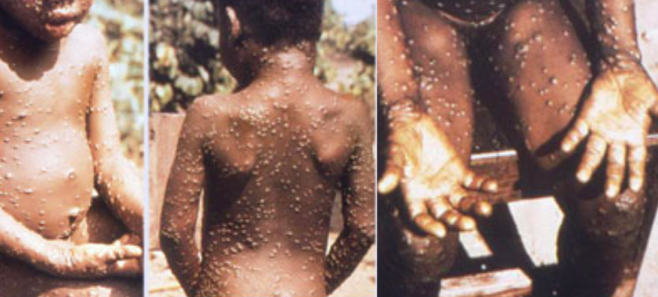 Monkeypox causes swollen lymph nodes, as well as fever, muscle aches and exhaustion (Wikipedia)