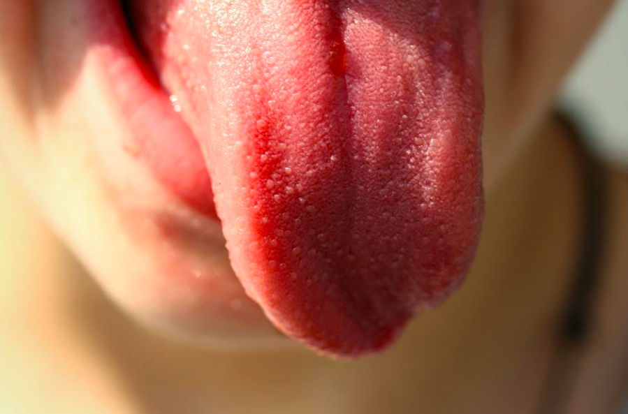 研究指出5種舌苔太厚、發白以及口氣不好的情況，可能代表的口腔疾病。（示意圖／翻攝自pixabay）