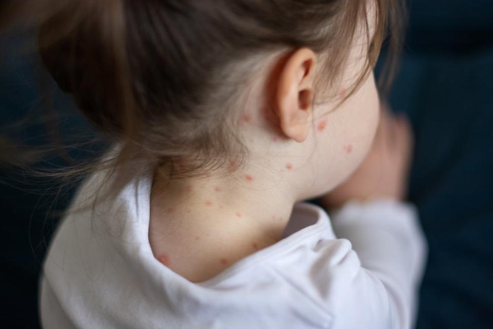 Measles can cause children to become seriously ill and hospitalised in certain cases (Getty Images)