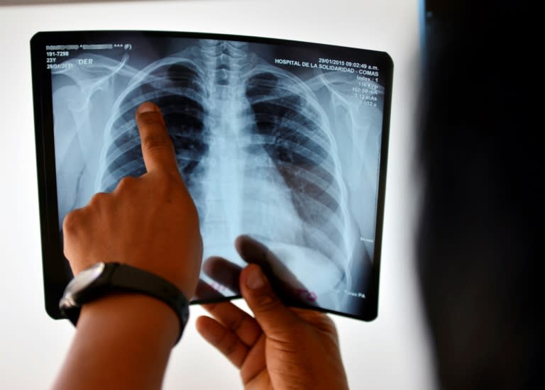 Tuberculosis killed an estimated 1.8 million people in 2015