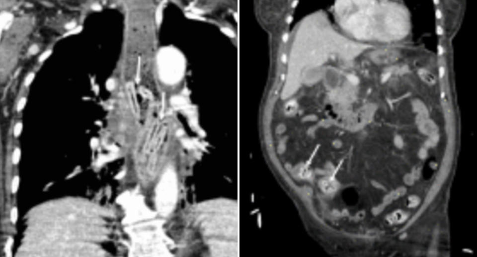 Crayons pictured in a CT scan lodged in the oesophagus of a woman.