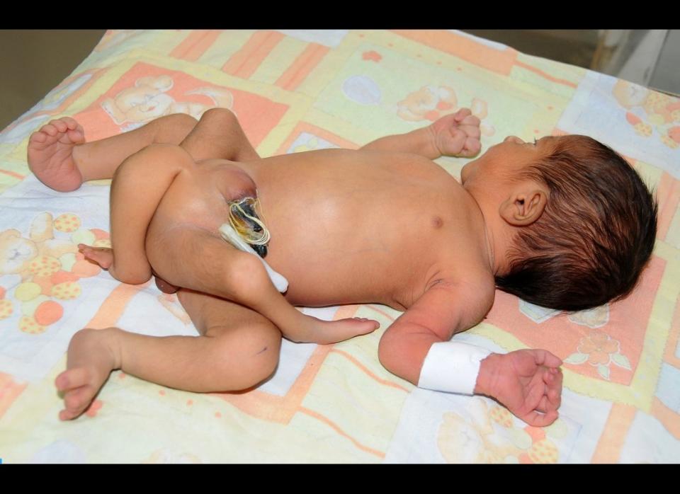 This baby with six legs was born in Sukkur, a city in the Sindh Province of Pakistan on Friday, April 13, 2012, according to the National Institute of Child Health. 