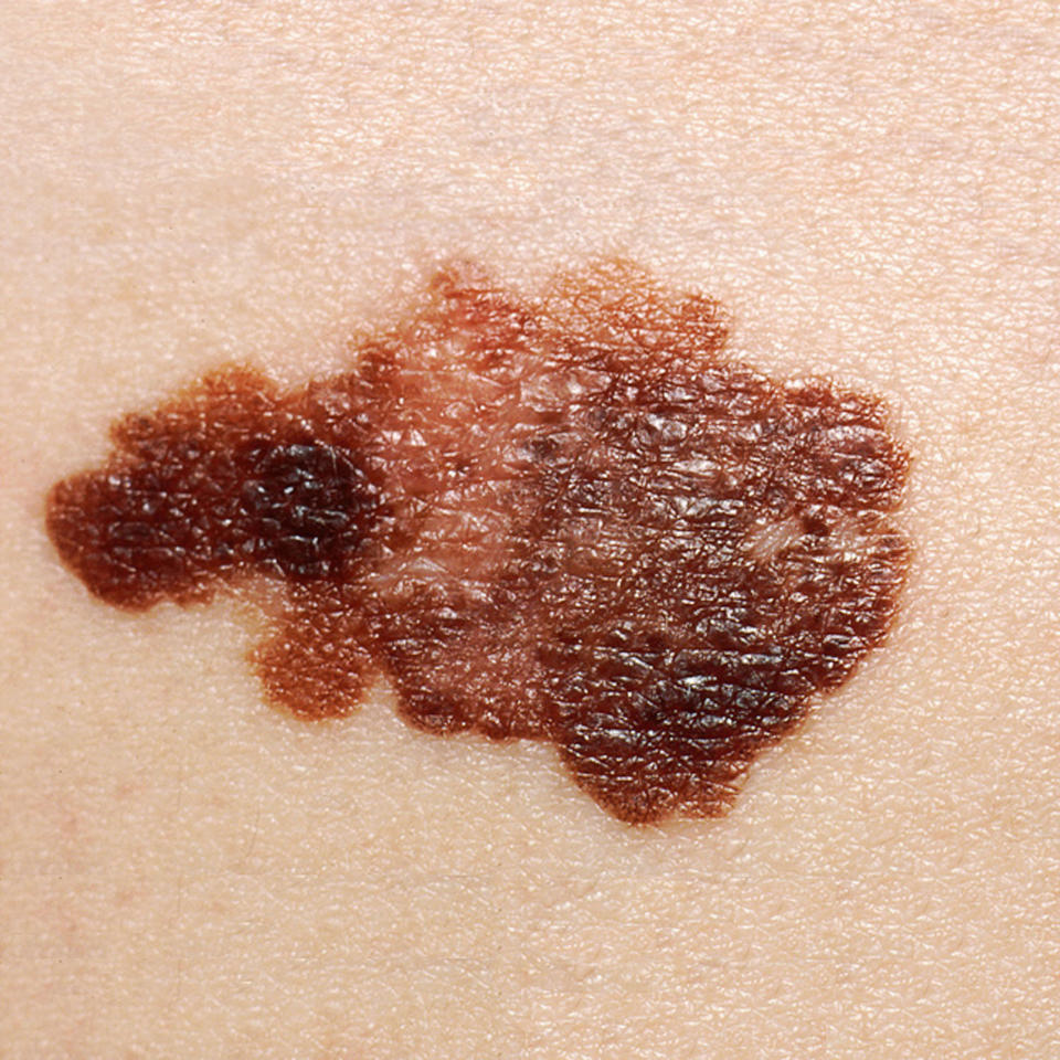 Skin cancer, particularly melanoma, is now the fifth most common cancer in the UK, killing around 2,300 people each year. (Getty)
