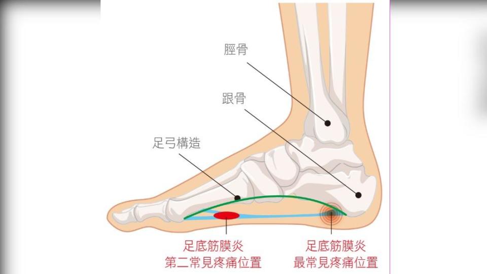 長時間走路可在鞋內加鞋墊，弧度與足弓貼合，緩衝踩地壓力。（圖／院方提供）