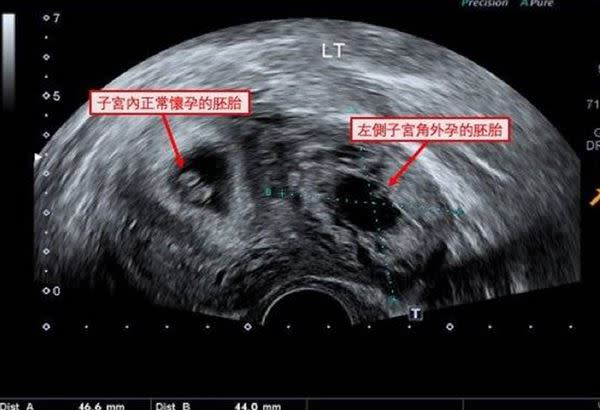 超音波檢查可見一個胚胎著床在左側子宮角。（圖片提供／台北長庚醫院）