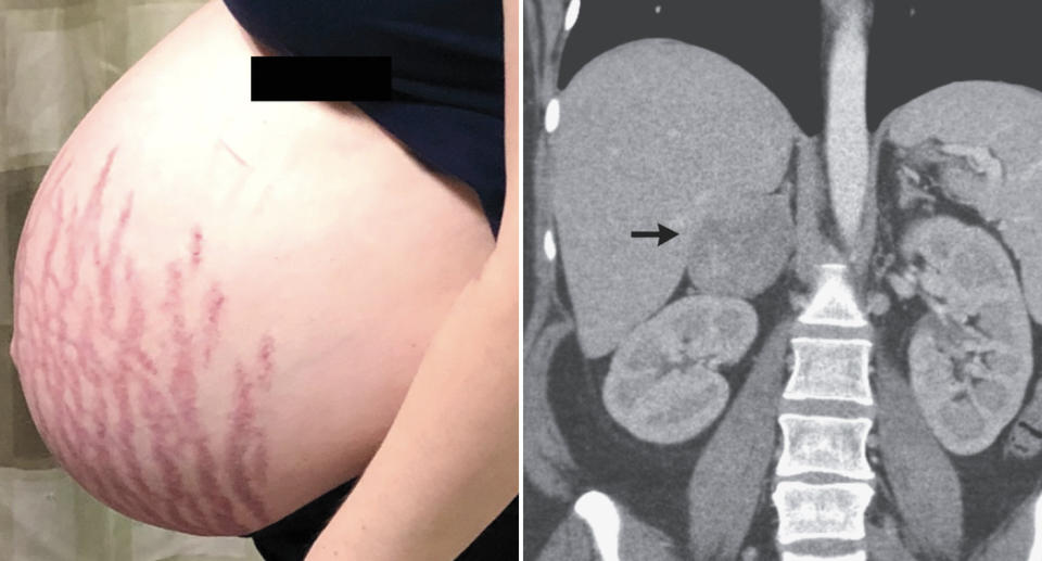 A pregnant woman's stomach is seen along with a CT scan of her abdomen.