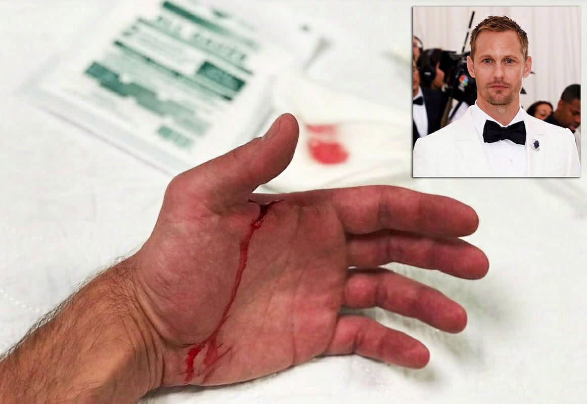 Looks like Alexander Skargard was thankful for his life this past Thanksgiving. The 'Big Little Lies' star, who is currently filming 'The Hummingbird Project' in Canada, cut his hand on Nov. 23, 2017 and was taken to a local hospital in Quebec for some stitches. The actor posted his injury on Instagram the same day, stating that "Today I give thanks to nurse Rosalie and doctor Taleb at the local hospital in Lachute, Quebec. Their swift and heroic action saved my life. #snitchesgetstitches".