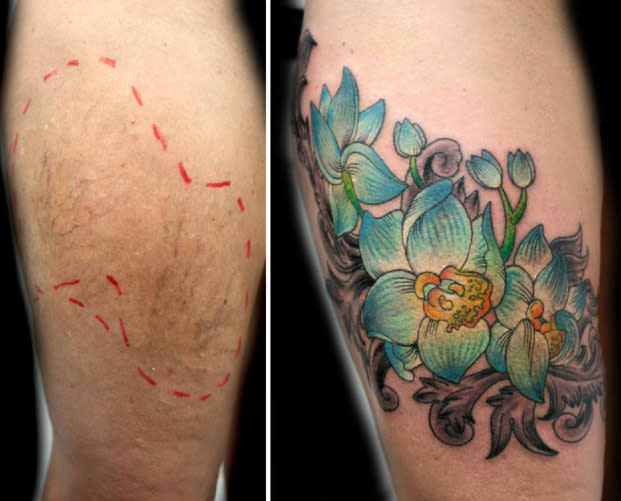Can You Tattoo Over Varicose And Spider Veins  Tattify