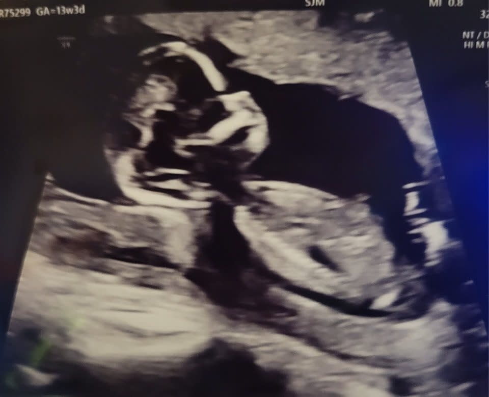 An ultrasound of her baby son revealed the child was without heartbeat. Katie Abdou / SWNS