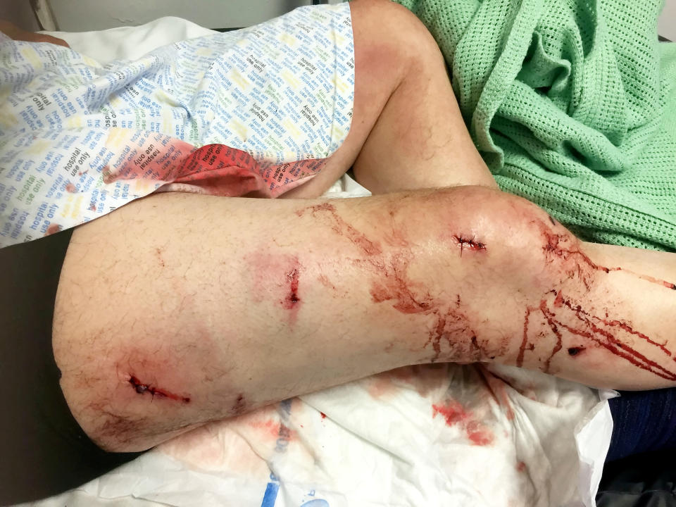 Shocking pictures show the injuries suffered by a grandfather following a hammer attack in a case of mistaken identity.  See SWNS story SWMDassault.  Dad-of-two Philip Jones, 63, said he is scared to return to his home after three masked men attacked him in the afternoon of July 13.  He had got in his car outside his flat at Riverside Park, Garden City, Flints., Wales, in order to go shopping with his partner Eileen O'Rourke, 53.  Three masked men came to his window and knocked, apparently thinking Mr Jones was someone else.  Although he tried to tell them he wasnt who they were looking for, they opened the car door and brutally hit him with hammers.  He was able to get away by reversing the car and went to hospital for treatment including stitches.