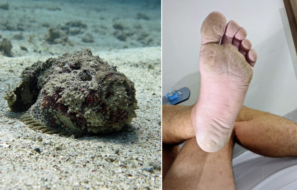 A stonefish on the sand under the water, and right the man's foot after stepping on the fish. Source: TikTok