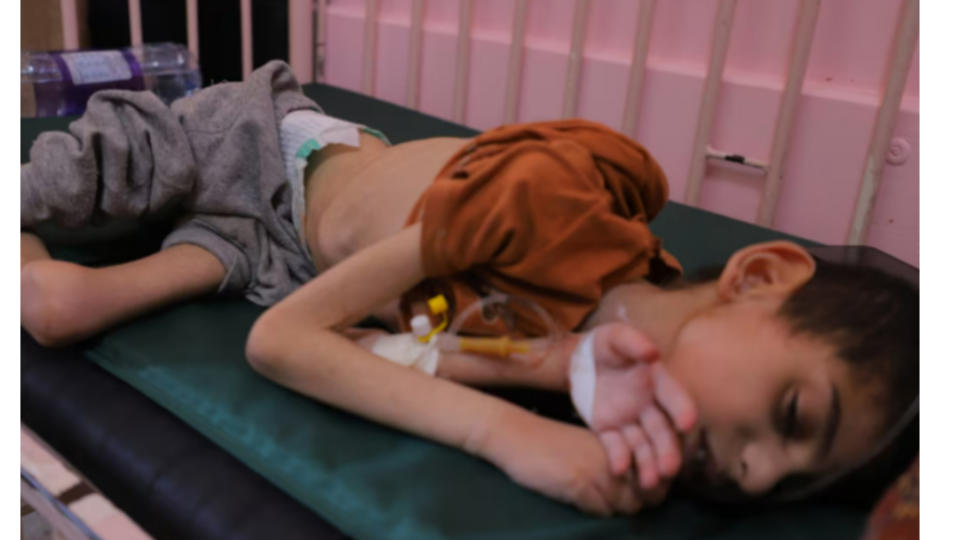 加薩走廊9歲男童尼斯祖馬（Yunis Jumaa）嚴重營養不良和脫水，瘦得只剩下皮包骨。翻攝CBC.CA