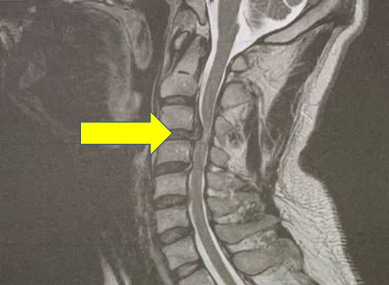 上圖箭頭指出曾先生頸椎間盤破裂，下圖為其人工椎間盤置入。（圖／阮綜合醫院提供）