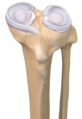 “The team is really pleased to be recognized with such a prestigious award to acknowledge this important, innovative product specifically designed to preserve the meniscus,” said Product Manager, Knee Ligament Julia Cuny. “[The SutureLoc™ implant is] a complicated anchor to produce and it provides an entirely new mechanism that we developed just for this implant. It was truly a team effort with over 20 teams contributing to the development.”