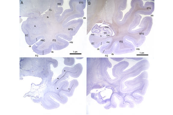 These higher-magnification photomicrographs show stained sections of the medial temporal lobe of EP (lower) and a control subject (upper), including the amygdaloid complex (A) and the hippocampal formation (B), both involved in memory and emoti