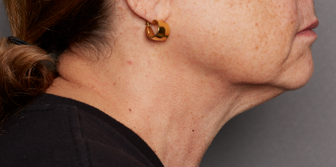 a side by side photo of a woman's neck before and after our neck cream test