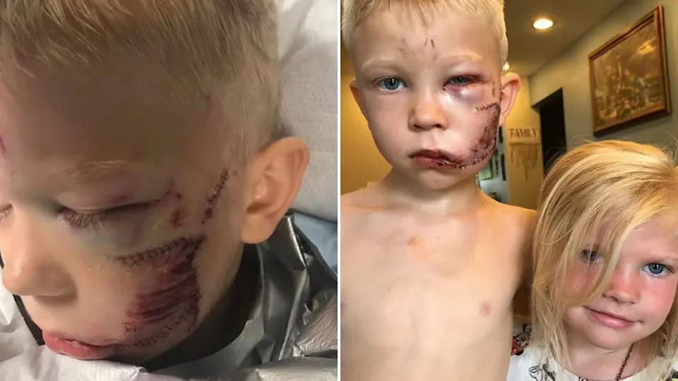 Bridger Walker pictured with facial injuries from a dog attack.