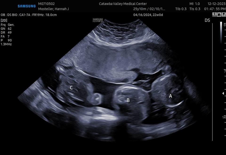 The first ultrasound, showing the Mosteller triplets.