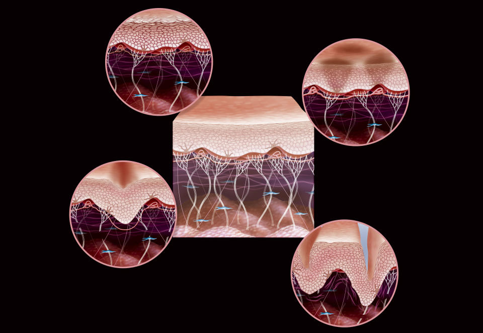 Illustration of the signs of ageing in skin, dulling of the epidermis, brown spots, skin slackening and wrinkles. In the centre of the image: a cross-section illustration of young skin enabling a comparison with different types of ageing: -Top left illustrates the dulling of the epidermis, the skin is dry and cutaneous microrelief is irregular, causing the skin to become permeable to pollutants and dehydration. Superficial microcirculation is less good; skin cells become less oxygenated. -Top right illustrates spots. If they are brown it is due to melanin deposits, when red it is due to superficial microcirculation vessels, which are dilated. -Bottom left illustrates the loss of firmness due to diminished activity of the fibroblasts (blue). Fibroblasts are responsible for skin's elasticity, producing elastin and collagen -Bottom right illustrates wrinkles due to the deterioration of collagen (white vertical) and elastin (pink horizontal) fibers. (Photo by: Jacopin/BSIP/Universal Images Group via Getty Images) (Photo: BSIP via Getty Images)