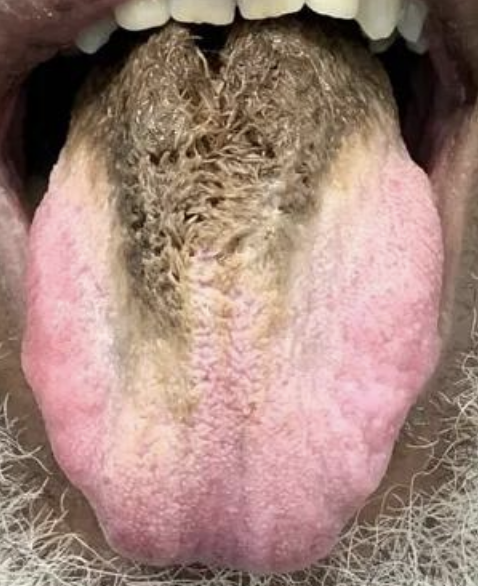 Close-up of a person's tongue displaying what looks like thick hair in the center