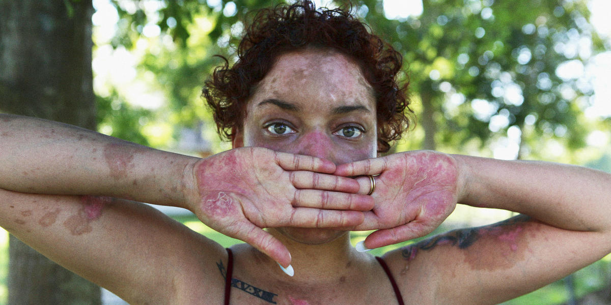 lupus rash on hands