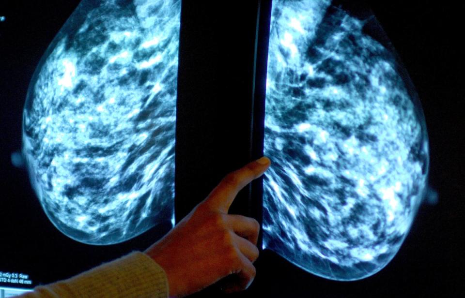 Una mamografía muestra la mama de una mujer que está siendo examinada para detectar cáncer de mama en el Derby City Hospital (PA)