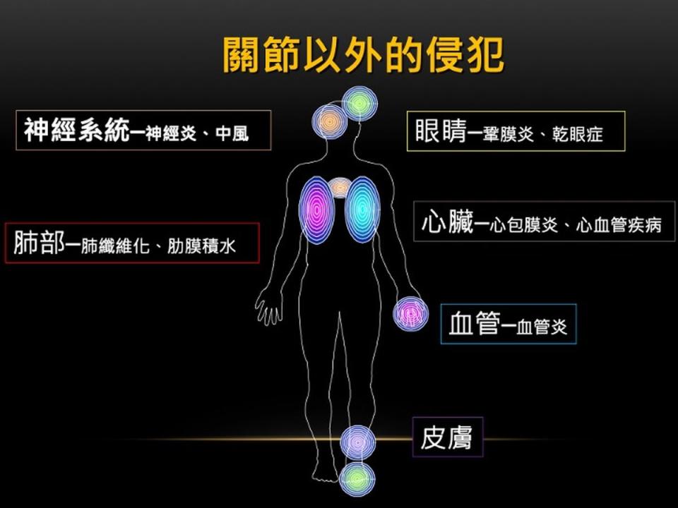 類風溼性關節炎若控制不良會導致關節外的全身性侵犯。（圖：台北榮總官網）