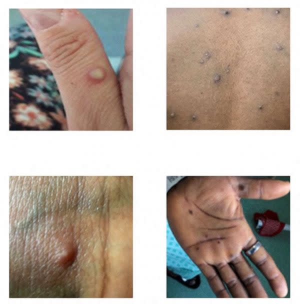 PHOTO: Pictures showing examples of rashes and lesions caused by the monkeypox virus are seen in this handout image obtained from the official Centers for Disease Control and Prevention (CDC) website on July 1, 2022. (NHS England High Consequence Infectious Diseases Network/CDC via Reuters)