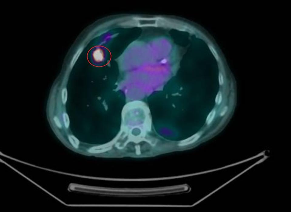 ▲正子攝影確認肺癌 (紅圈處)。（彰化醫院提供）