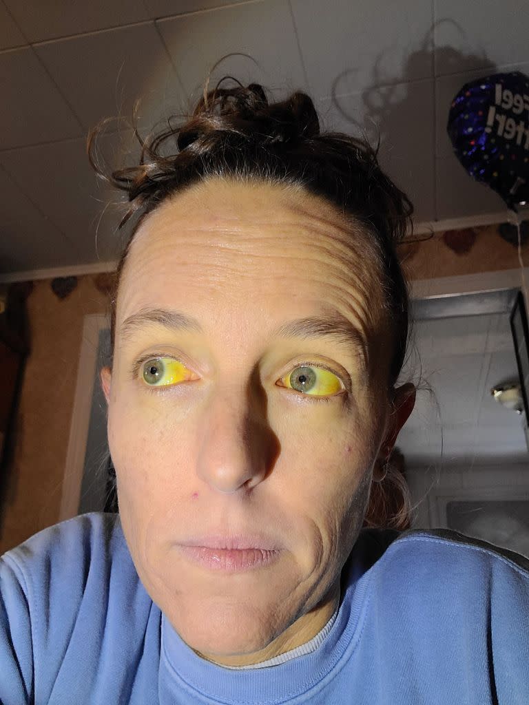 A Pennsylvania mom says a store-bought herbal remedy she used to treat her menopause symptoms made her skin so yellow that she was left looking like Marge Simpson. KennedyNews/AmberHeimbach