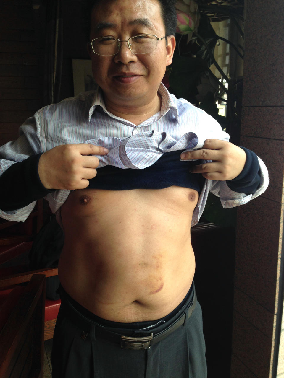 In this Monday, April 7, 2014 photo released by Xiang Li, Chinese lawyer Jiang Tianyong rolls up his shirts to show bruises on his body, which he claims were sustained from being beaten by police, at a restaurant in Beijing. Jiang is among a group of four Chinese rights lawyers who allege they were tortured by police after being rounded up in late March outside a detention center in a farming community on the northeastern edge of China. They had joined several people in shouting to demand information about relatives believed locked up inside because they were members of Falun Gong - banned as a cult though they claim to be a peaceful spiritual movement. (AP Photo/Xiang Li)