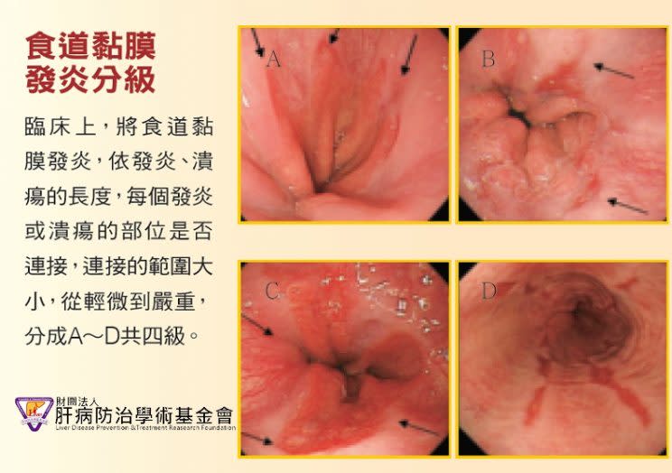 Esophageal mucosal inflammation