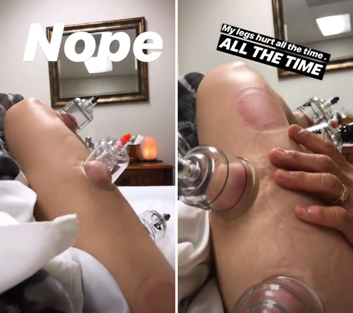 Kaley-Cuoco-Post-Workout-Cupping-Therapy-Video