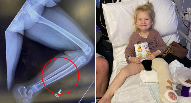 Parents' plight after ANOTHER child breaks leg on NSW slide