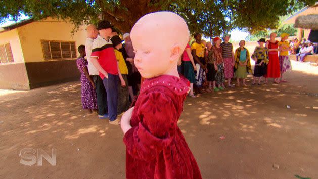 An albino orphan in Tanzania's Mwanga district