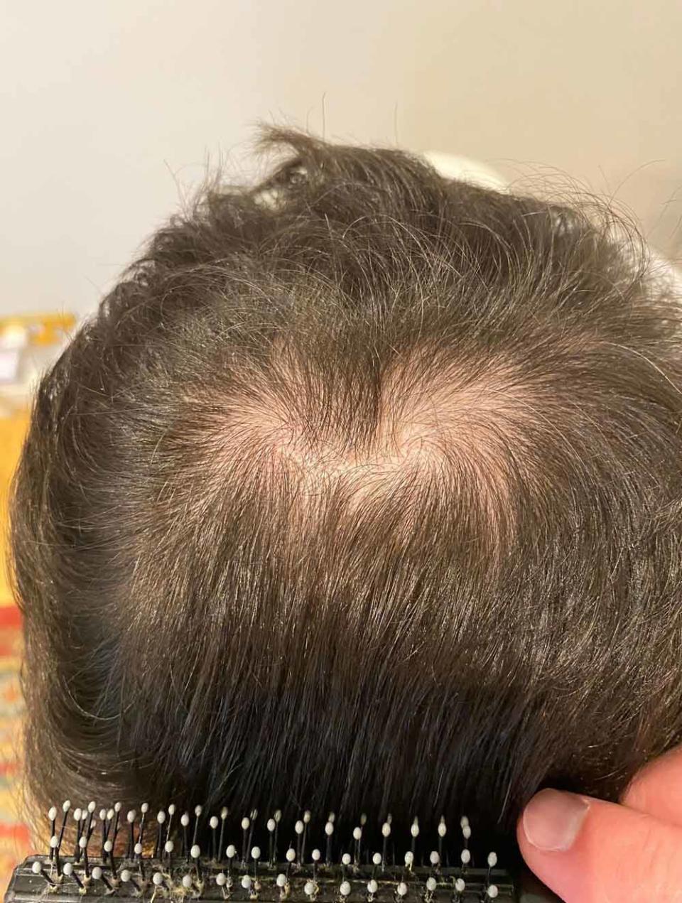 Cosmin’s bald patches from his alopecia are now beginning to grow back. (Collect/PA Real Life)