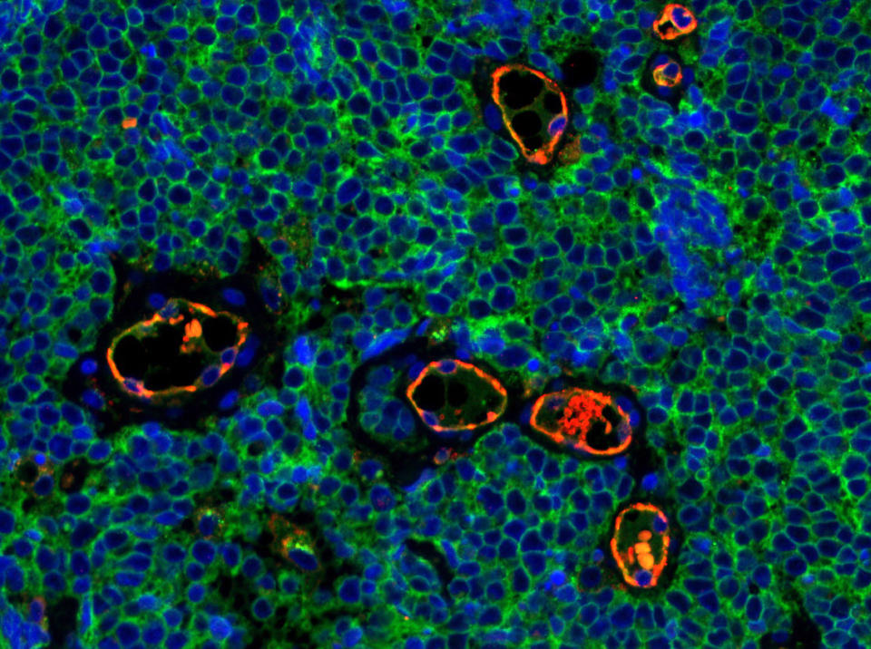 An immunofluorescent staining of a Merkel cell carcinoma tumour tissue. (Photo by Isaac Brownell, National Institute of Arthritis and Musculoskeletal and Skin Diseases/NIH)