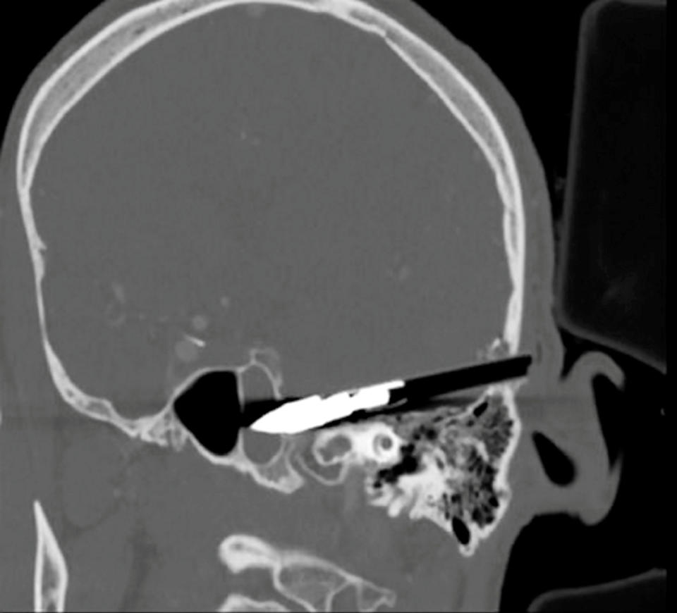 An X-ray of the crossbow bolt embedded in the victim's head. (SWNS)